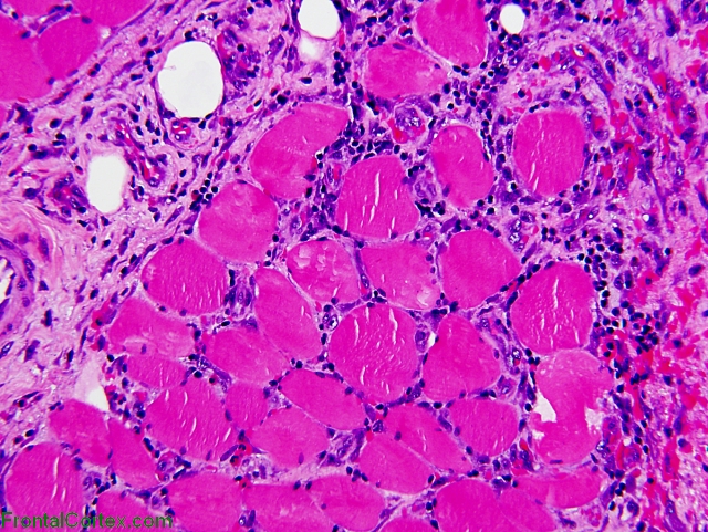 H&E - Example of pathological findings